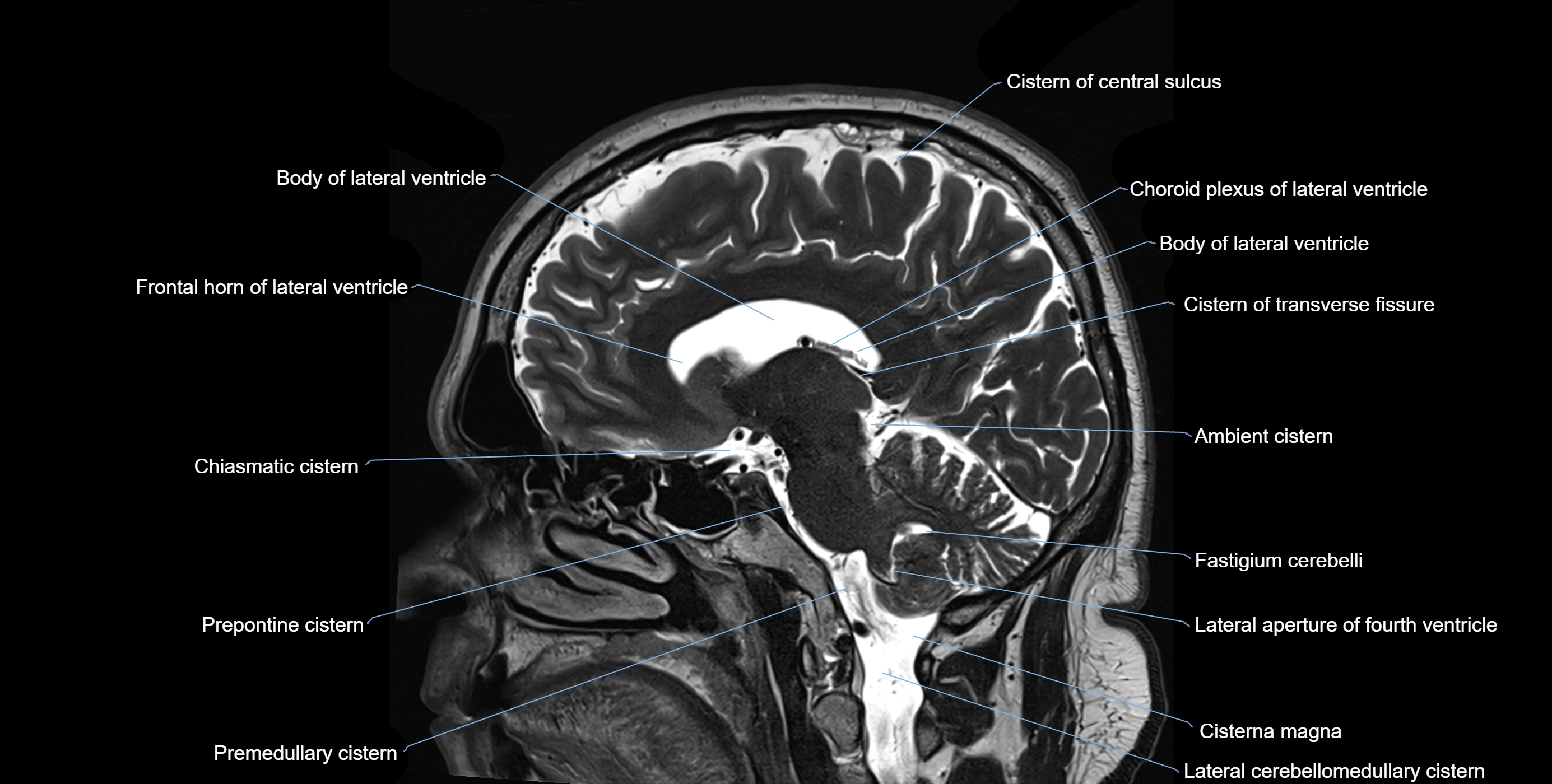 Brain cisterns  and ventricles sagittal anatomy 3T MRI image-img-00001-00033.webp